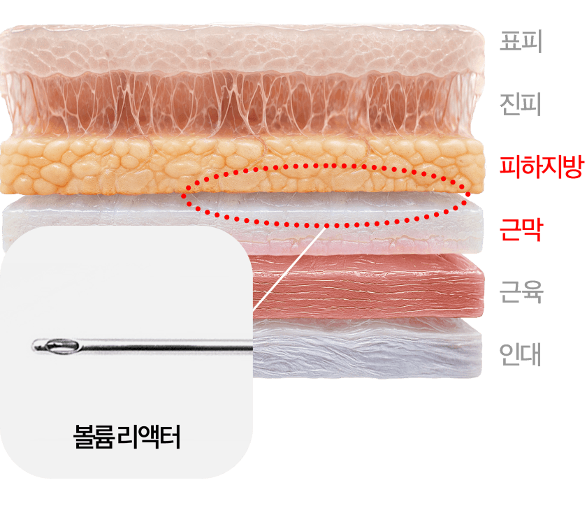 볼륨 리액터 주입 층 단면도
